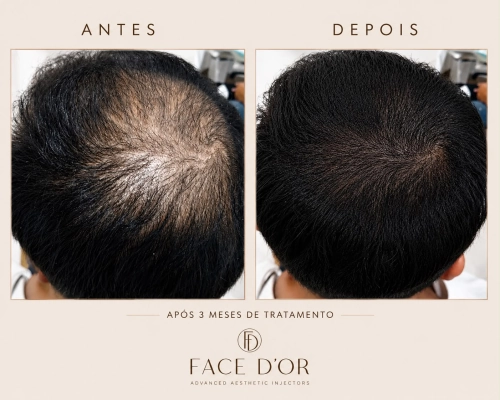Antes e depois do tratamento capilar para fortalecimento dos fios em Vila Andrade