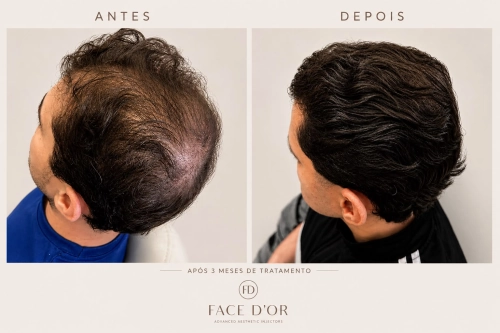Antes e depois do tratamento para aumento da densidade capilar em Morumbi