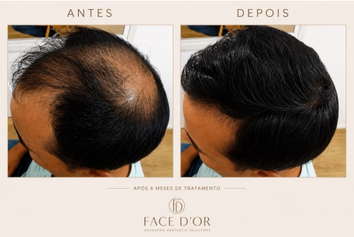 Antes e depois do tratamento estético capilar com resultados naturais em Panamby
