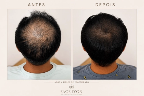 Evolução do tratamento capilar com antes e depois em Jardim Sul