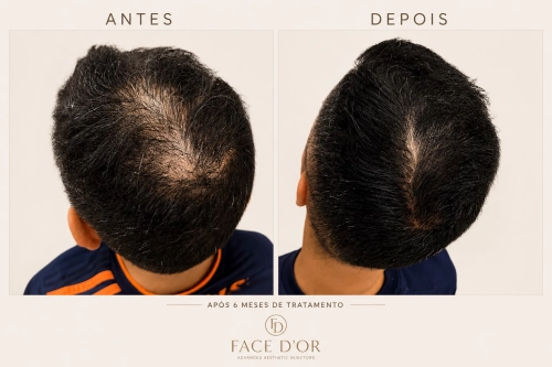 Resultados do tratamento capilar com antes e depois em Morumbi