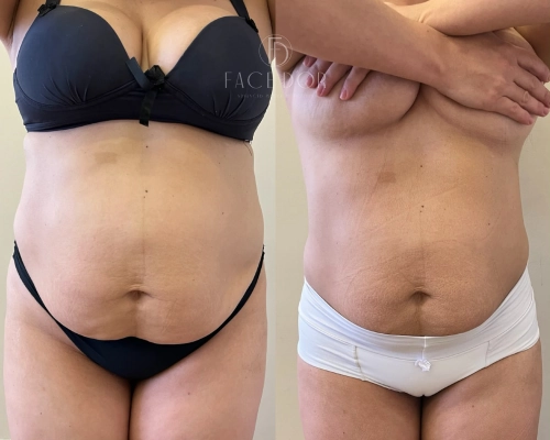 Transformação corporal antes e depois do tratamento estético em Panamby