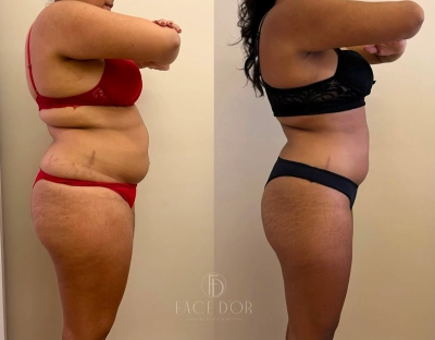 Antes e depois do tratamento corporal para redução de medidas em Morumbi