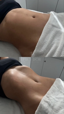 Resultado do tratamento corporal com melhora do contorno corporal em Vila Andrade