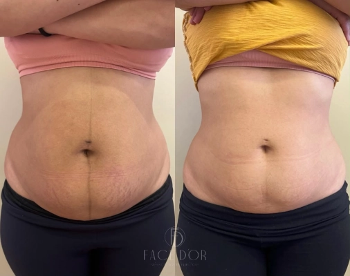 Antes e depois do tratamento para gordura localizada em Portal do Morumbi