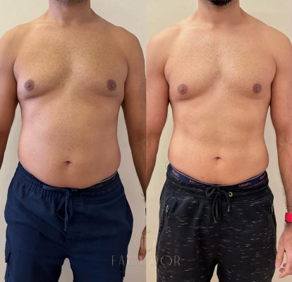 Tratamento corporal com redução de medidas e definição do corpo em Panamby
