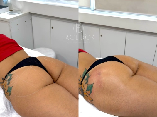 Antes e depois do tratamento estético corporal realizado em Jardim Sul