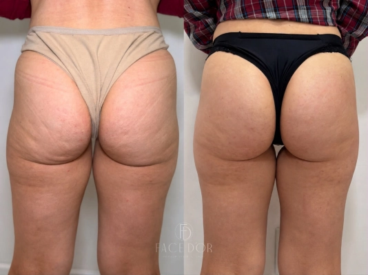 Antes e depois da evolução estética corporal em Portal do Morumbi