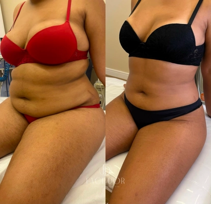 Antes e depois do tratamento corporal em Morumbi