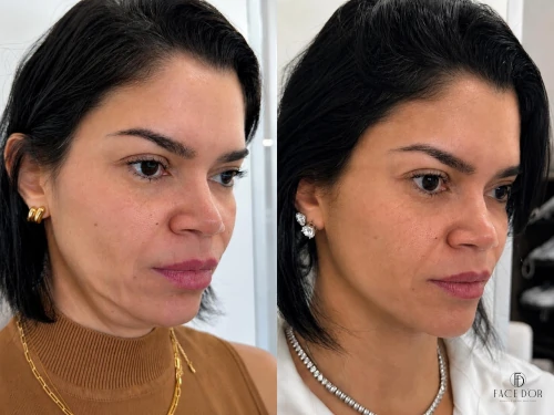 Antes e depois da harmonização facial em Portal do Morumbi