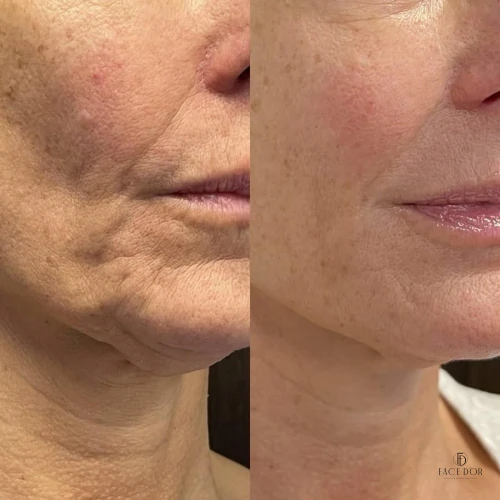 Resultado da harmonização facial em Jardim Sul