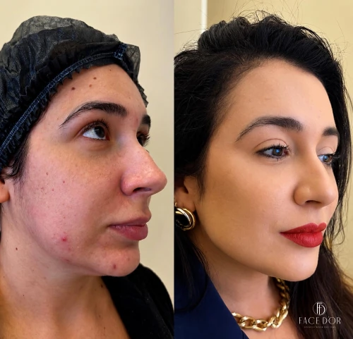 Antes e depois da harmonização facial em Vila Andrade