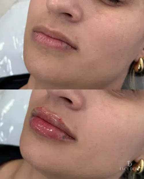 Antes e depois do preenchimento labial em Vila Andrade