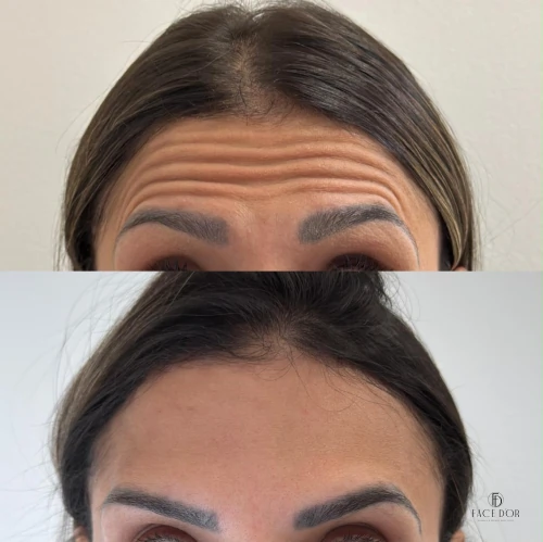 Resultado do Rejuvenescimento Facial em Panamby